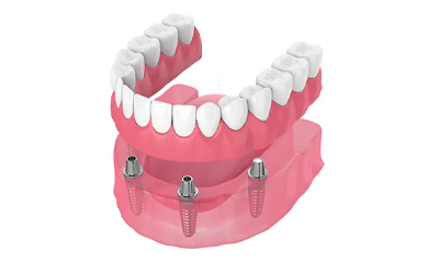 Prótesis sobre implantes