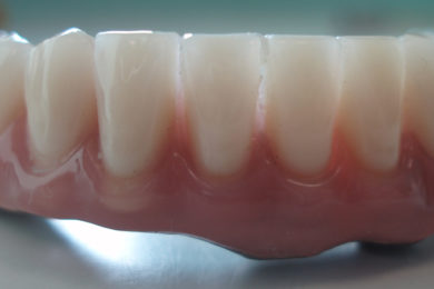 Prótesis fijas en Zirconio