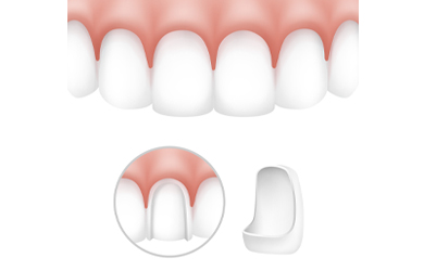 Carillas estéticas dentales